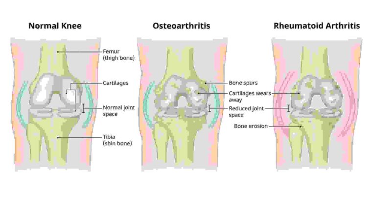Which medicine is best for arthritis?